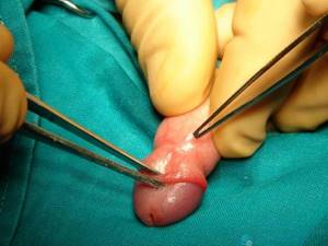 Лечение фимоза у мальчиков консервативным и хирургическим путем