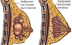 Мастопатия при грудном вскармливании: возможно ли выздоровление