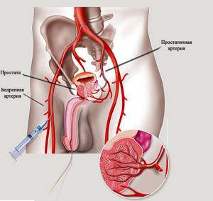 Эмболизация артерий простаты: техника проведения процедуры
