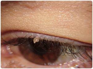 Бородавки на глазах: симптомы и основные способы удаления