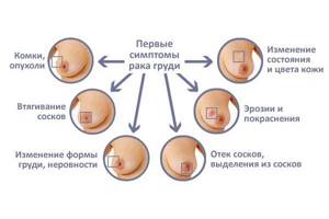 Виды мастопатии молочных желез: общепринятая классификация