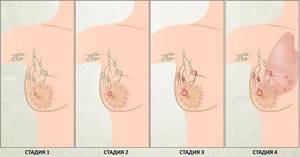 Симптомы рака груди и основные подходы к лечению заболевания