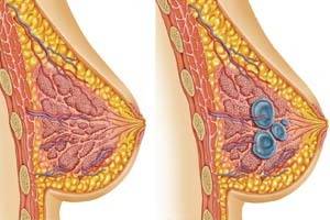 БАДы при мастопатии: список разрешенных к применению средств