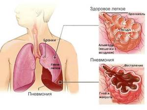 Пневмония без температуры, но с кашлем: лечение патологии