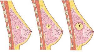 Железисто фиброзная мастопатия: ее формы и тактика лечения