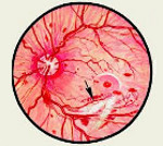 Лечение диабетической ретинопатии и профилактика осложнений