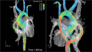 Что показывает магнитно-резонансная томография сосудов сердца