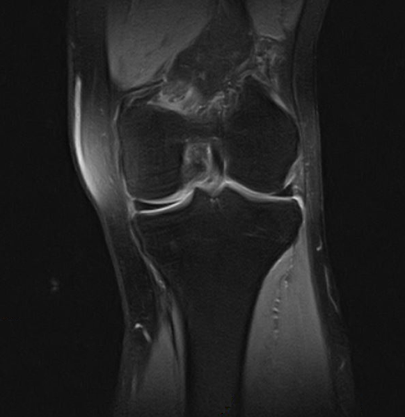 Показания к магнитно-резонансной томографии коленного сустава