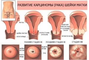 Бородавки на половых органах: диагностика и терапия патологии