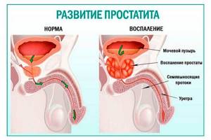 Гиперплазия предстательной железы: признаки и лечение заболевания
