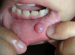 Бородавка во рту: причины появления и методы устранения патологии