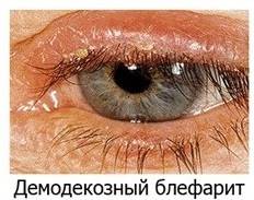 Лечение блефарита и профилактика развития заболевания глаз
