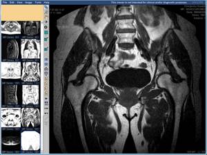 Показания к проведению МР-томографии тазобедренного сустава