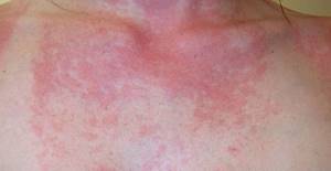 Симптомы и лечение аллергии на солнце различной этиологии