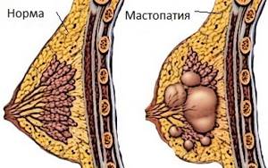 Мастопатия: различные причины развития патологического процесса