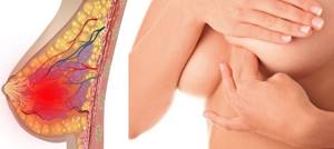 Лечение мастопатии: максимально эффективно, просто и быстро