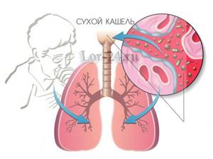 Сухой кашель: провоцирующие факторы и способы терапии симптома