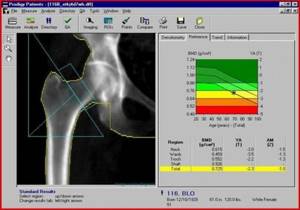 Особенности проведения денситометрии для диагностики остеопороза