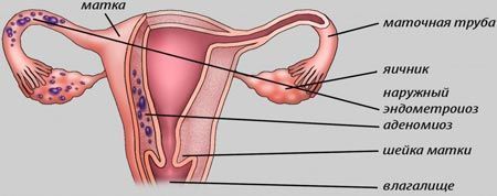 Симптомы аденомиоза матки и основные методы лечения патологии