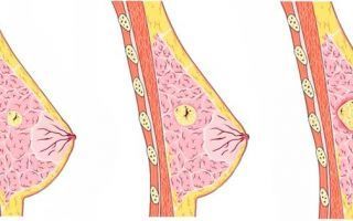 Железисто фиброзная мастопатия: ее формы и тактика лечения