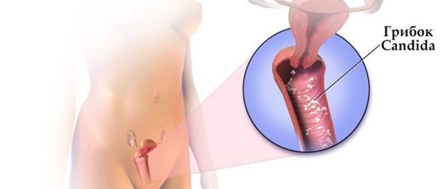 Симптомы и основные методы лечения кандидозного вульвовагинита