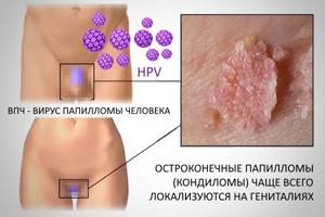 Косвенные признаки вируса папилломы человека и пути заражения