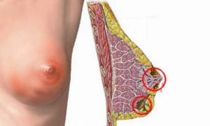 Двусторонняя диффузная фиброзно кистозная мастопатия: симптомы