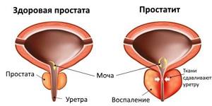 Предстательная железа: лечение и профилактика патологий органа