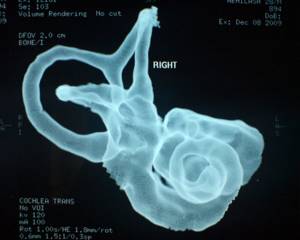 Проведение компьютерной томографии уха при проблемах слуха