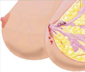 Папилломы на груди: клиническая картина и методы лечения наростов