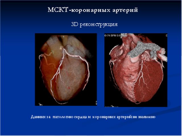Показания для проведения компьютерной томографии сердца и сосудов