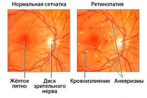 Симптомы ретинопатии и методы лечения воспалительной патологии