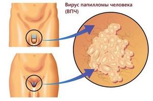 Аногенитальные бородавки: диагностика и лечение образований
