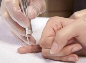 Папилломы на руках: методы диагностики и лечения наростов