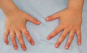 Папилломы на руках: методы диагностики и лечения наростов