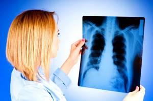 Кашель при туберкулезе: специфические признаки и методы лечения