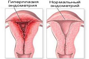 Симптомы гиперплазии эндометрия и возможные причины нарушения