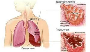 При каких патологиях появляется кашель и боль в грудной клетке