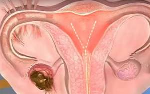 Симптомы кисты в яичнике и основные методы лечения патологии