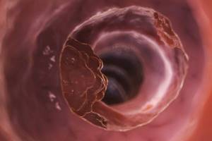 Папилломы в кишечнике: диагностика и лечение новообразований