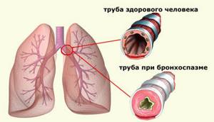 Почему при кашле отмечается затруднение дыхания и одышка
