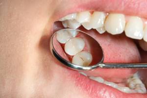 Симптомы фиссурного кариеса и методы лечения заболевания зубов