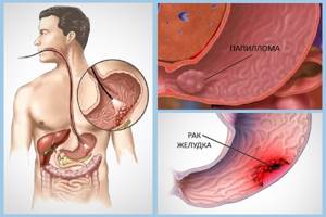 Папилломы в желудке: причины появления и методы лечения наростов