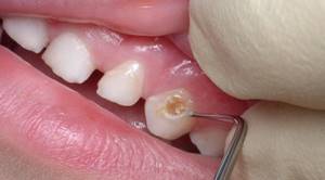 Причины появления и основные симптомы развития кариеса зубов