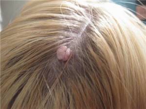 Бородавка на голове в волосах: диагностика и лечение нароста