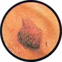 Папиллома мочевого пузыря у мужчины: диагностика и лечение