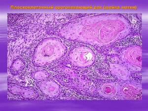 ВПЧ и рак шейки матки: методы диагностики и лечения заболевания
