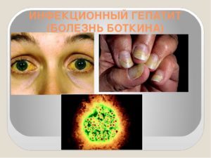 Симптомы болезни Боткина и основные методы лечения заболевания