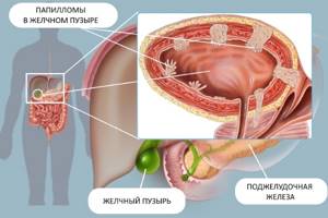 Папилломы в желчном пузыре: симптомы и методы лечения наростов