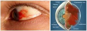 Лечение гемофтальма и профилактика развития заболевания глаз